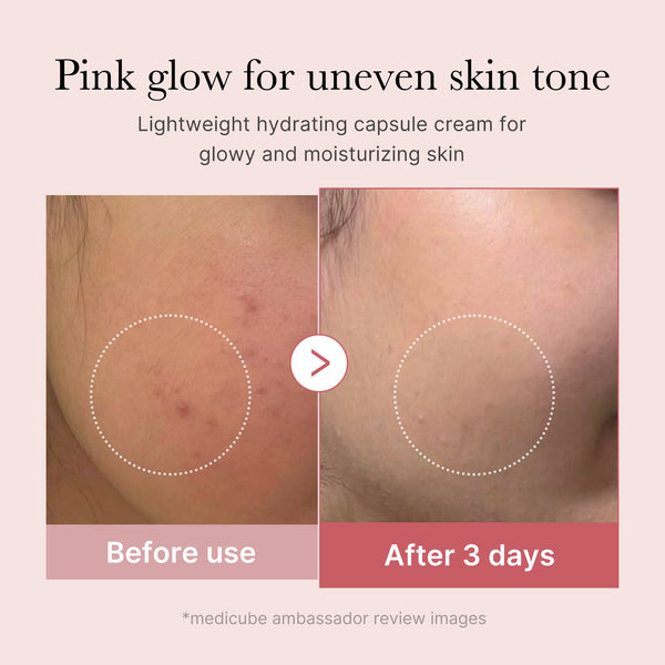 Uneven Tone & Spot Care