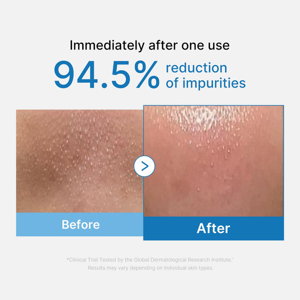 1-Step Blackhead Dissolution